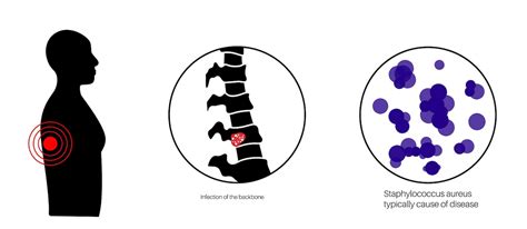 Osteomielite Vertebral Infectado Sequestro De Ossos Da Coluna Vertebral