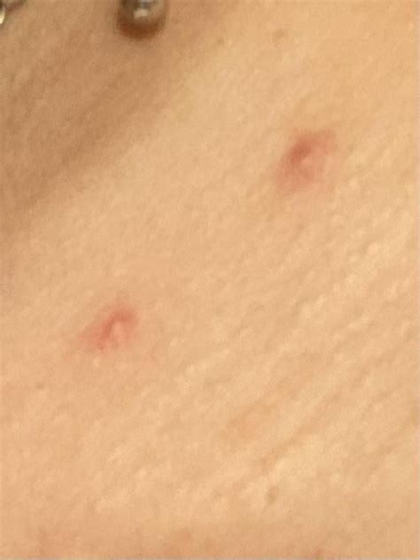 Acne Or Bug Bites R Dermatologyquestions