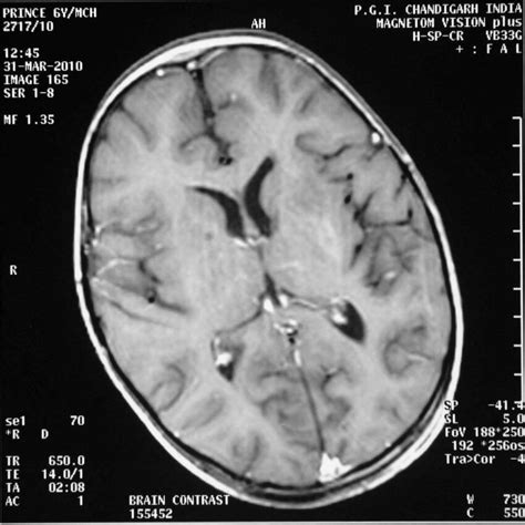 (PDF) MRI 2 T1: Contrast enhanced magnetic resonance imaging (MRI) of the brain showing infarct ...