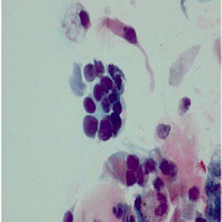 Bronchoalveolar lavage fluid cytology (× 600) showing small cell lung ...