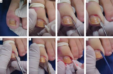 Figure From Nail Matrix Phenolization For Treatment Of Ingrowing Nail