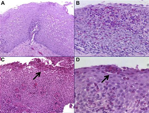 Histology Of The Esophagus Mucosal Biopsy Specimens A Normal