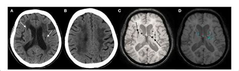 A) Lacunar infarcts (LIs) are seen in the bilateral basal ganglia on... | Download Scientific ...