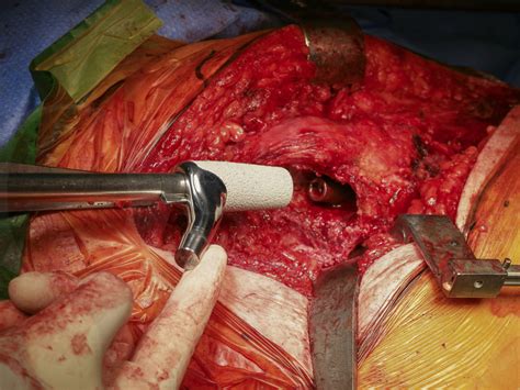 Revision Hip Replacement Femoral Revision With An Uncemented