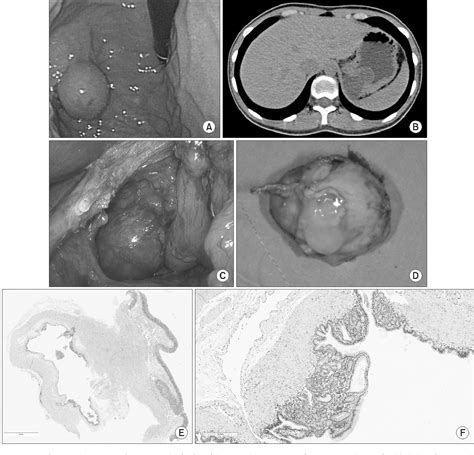 Figure 1 From Gastric Duplication Cysts In Adults A Report Of Three Cases Semantic Scholar