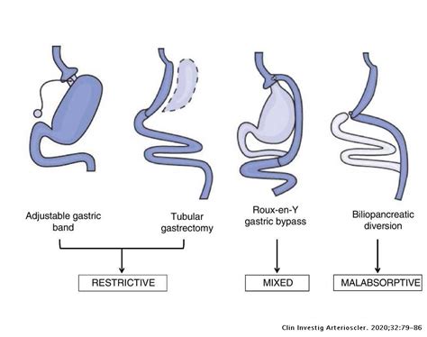 Morbid Obesity And Dyslipidaemia The Impact Of Bariatric Surgery