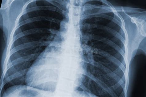 Ricerca Dell Esame Radiografico Del Torace Immagine Stock Immagine Di