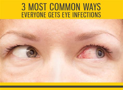 3 Most Common Sources for Eye Infections