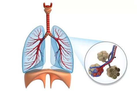 Idiopathic Fibrosing Alveolitis - Symptoms, Treatment, Forms, Stages ...