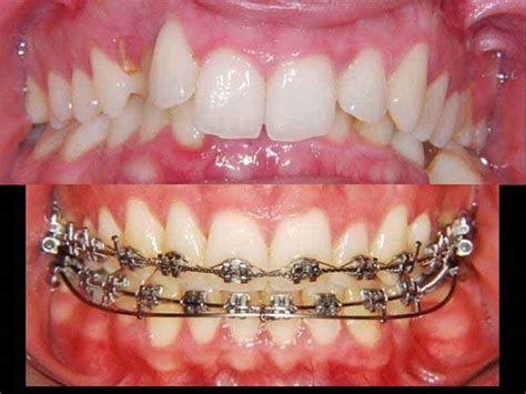 Orthodontic Treatment In Kochi Best Orthodontics In Kochi