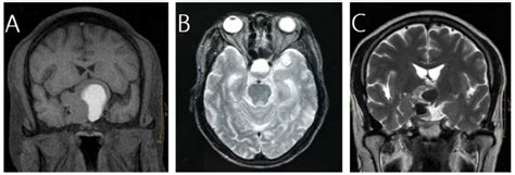 Magnetic resonance images of three cases of pituitary hemorrhage. A, a ...