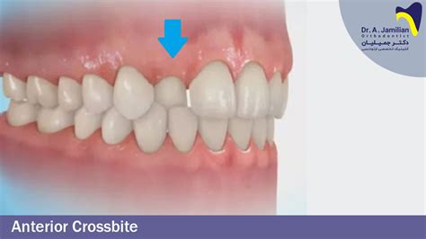 Anterior Crossbite Dr Jamilian