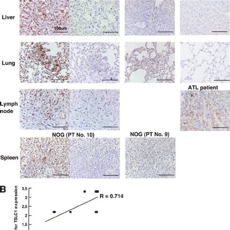 Growth And Infiltration Of Primary Atl Cells In Various Organs Of Nog