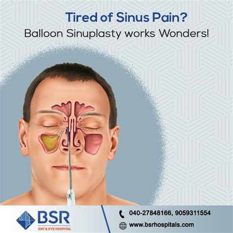 Functional Endoscopic Sinus Surgery Felicity Hill