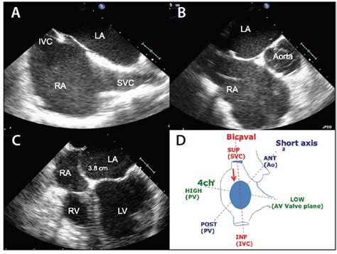 Transseptal Puncture A Step By Step Procedural Guide Cardiac