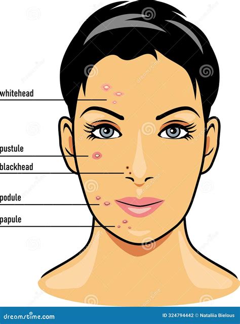 Different Types Of Facial Skin Acne Stock Illustration Illustration