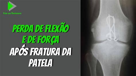 O que fazer para melhorar mobilidade e força após cirurgia da patela