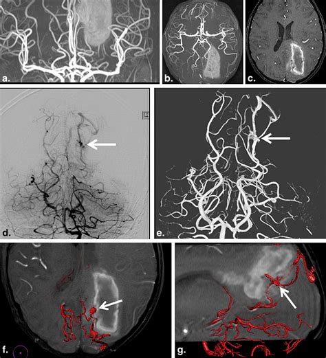 Usefulness Of 3D DSA MR Fusion Imaging In The Pretreatment Evaluation