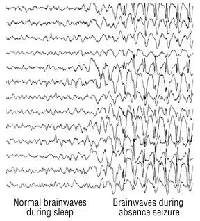 Electroencephalogram (EEG) Guide