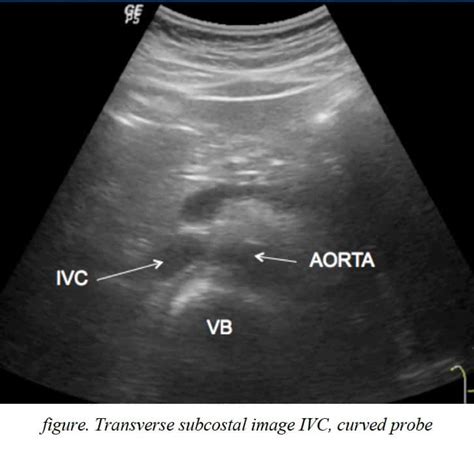 3 IVC Ultrasound Pre-reading for FCUS Course - Intensive Care Network