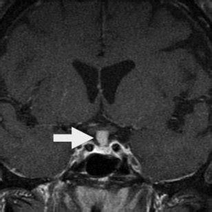 Magnetic Resonance Imaging MRI Of The Submandibular Glands MRI