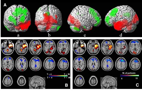 Figure 1 From Correlations Of Interictal Fdg Pet Metabolism And Ictal