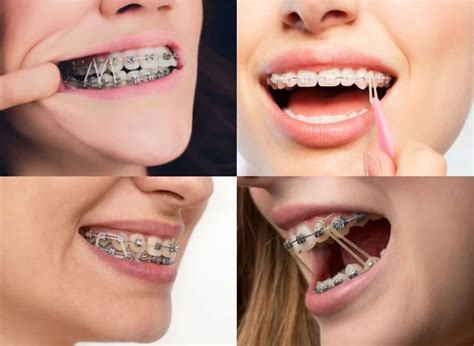 What Do Rubber Bands Do On Braces Oc Dental Center