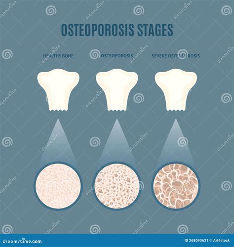 Osteoporosis Bone Density Loss Disease Medical Infographics Stock