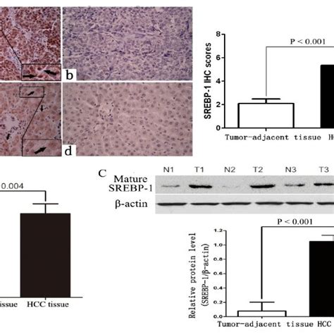 srebp  expression  hcc cases  immunostaining  srebp   hcc