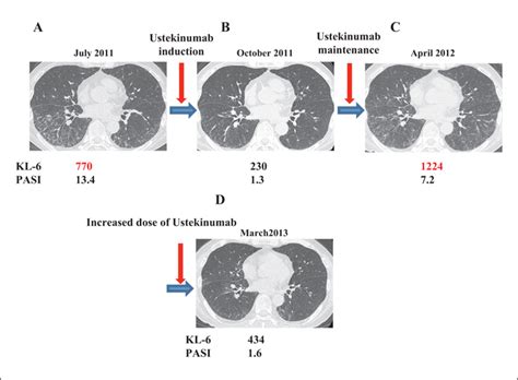 Jle European Journal Of Dermatology Psoriasis Associated Interstitial Pneumonia