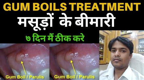 How To Cure Gum Disease Best Treatment For Gum Disease Gum Boils