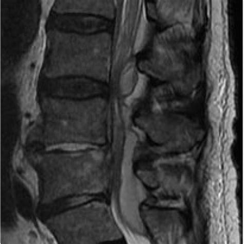 Spinal epidural abscess as seen on magnetic resonance imaging of the... | Download Scientific ...