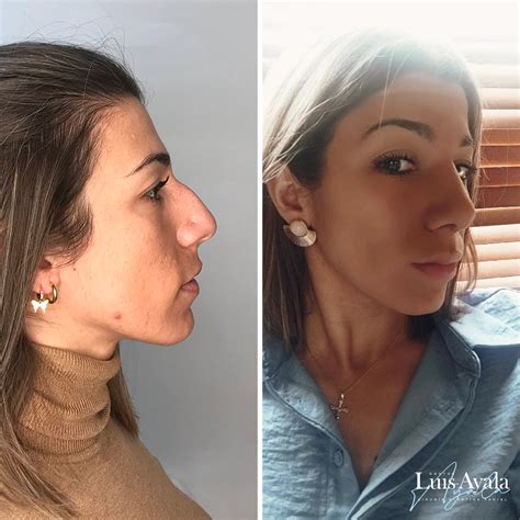 Fotograf As Antes Y Despu S De Rinoplastias Dr Luis Ayala