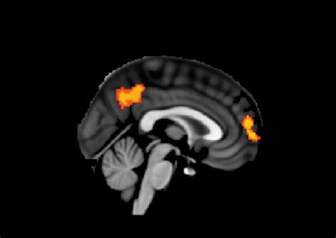 Abnormal Brain Activation IMAGE EurekAlert Science News Releases