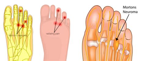 Morton S Neuroma Mr Daniel Goldbloom Melbourne