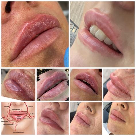 What Does Lip Filler Cost The Clinic Aesthetics In Hereford