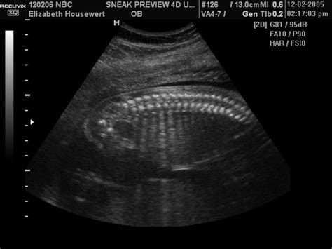 Dexters 20 Week 4d Ultrasound Spine