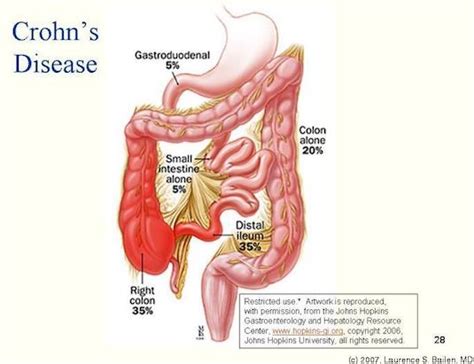 Crohns Disease Gastroenterology Of Greater Orlando