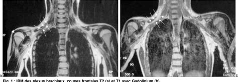 Pdf Neuropathie Hypertrophique Localis E Nhl Du Plexus Brachial