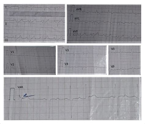 Electrocardiogram of the patient. | Download Scientific Diagram