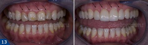 Услуги - Коронка из диоксида циркония