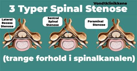Lateral Recess Stenose I Ryggen Lambertseter Kiropraktorsenter