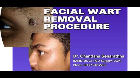 Facial Wart Removal Procedure Ayurveda Agnikarma Treatment Youtube