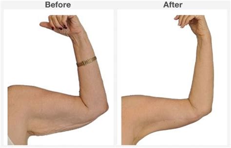 Arm Lift Surgery | Before And After Photos | Dr. Peterson