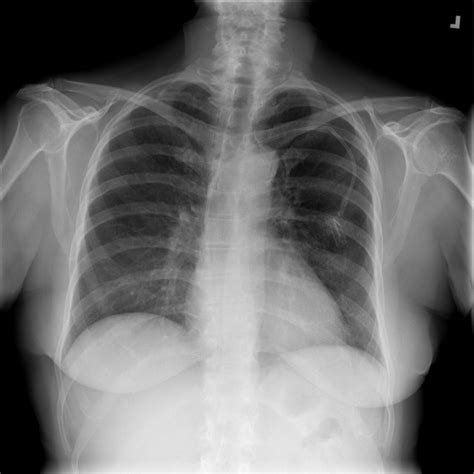 Pdf Comparison Of Deep Learning Approaches For Multi Label Chest X