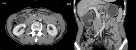 Severe Duodenal Ulcer Behaves Like Gastroduodenal Intussusception The Annals Of The Royal