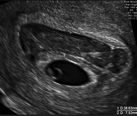 First‐trimester Intrauterine Hematoma And Pregnancy Complications Al