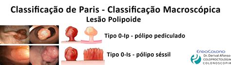 Polipo De Reto Polipectomia - Polipo colorretal - COLONOSCOPIA - COLOPROCTOLOGIA - ENDOSCOPIA