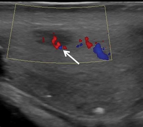 Testicular Tumors What Radiologists Need To Know—differential