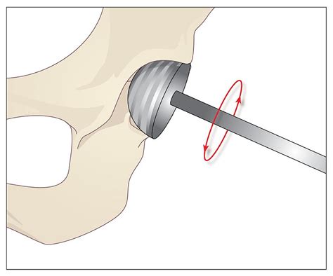 Hip Replacement Artwork Photograph By Peter Gardiner Pixels